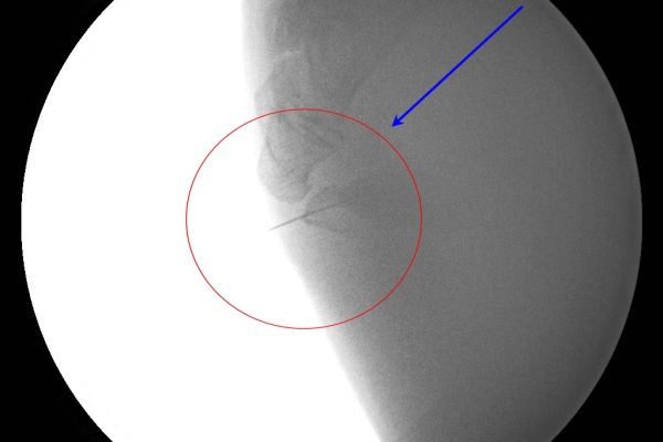 tailbone-broken w needle